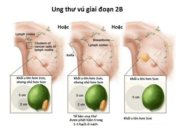 Minh họa ung thư vú ở giai đoạn 2B