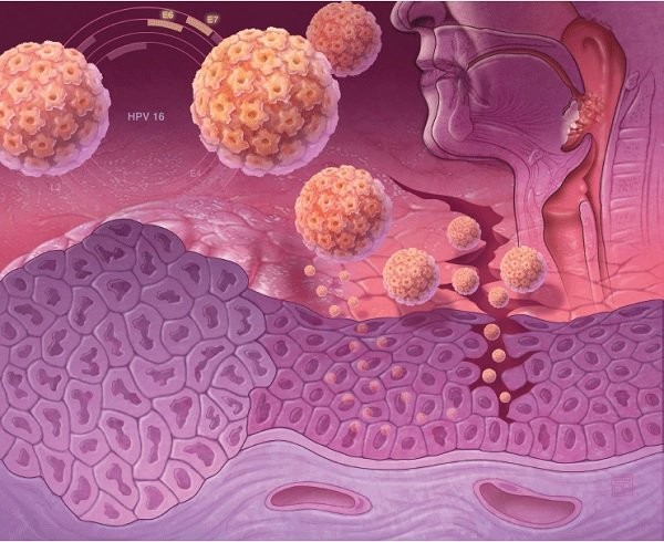 Hình 2: Chủng HPV 16 là chủng tham gia nhiều vào việc gây ung thư miệng, hầu họng, cổ tử cung