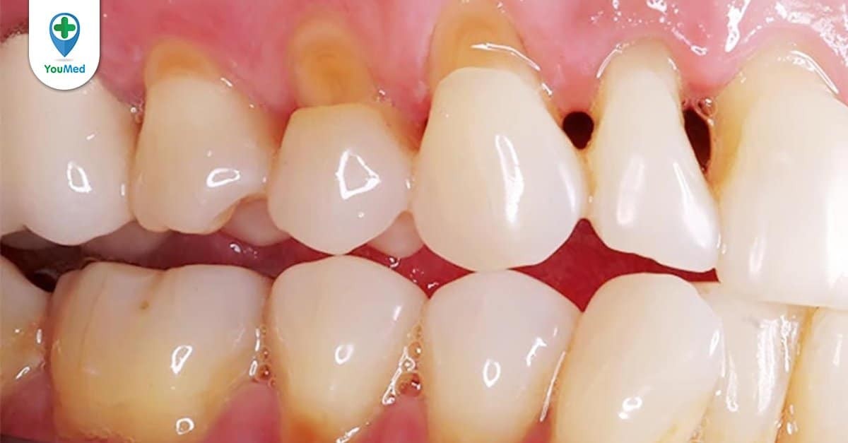 Sâu răng có thể ảnh hưởng đến sức khỏe toàn thân như thế nào?
