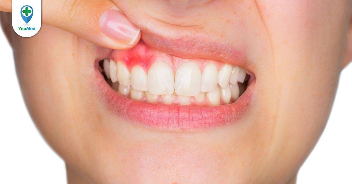 Có những biện pháp phòng ngừa nào để tránh viêm chân răng cần sử dụng thuốc kháng sinh?
