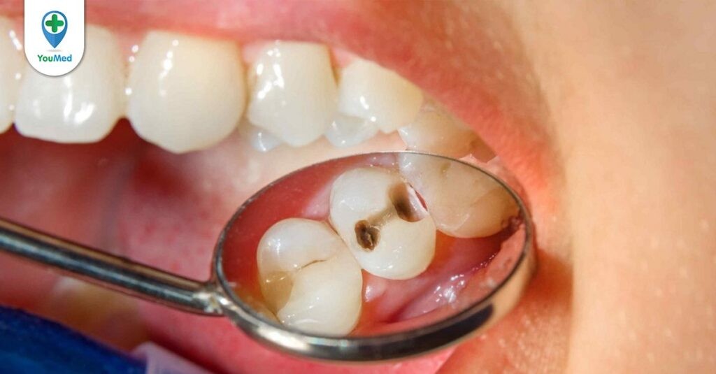 Bác sĩ bật mí những cách trị sâu răng tại nhà cho bạn