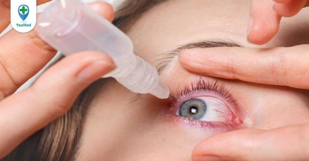Top 5 thuốc nhỏ mắt trị ngứa mắt tin dùng – Lời khuyên từ bác sĩ