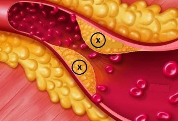 Tăng cholesterol xấu tạo thành các mảng bám trong các thành mạch