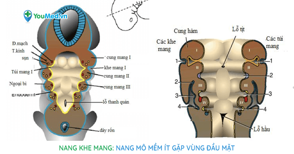 Nang khe mang: Nang mô mềm ít gặp vùng đầu mặt