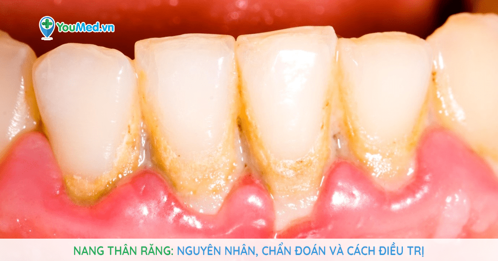 Nang thân răng: nguyên nhân, chẩn đoán và cách điều trị