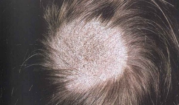 Nhiễm nấm da đầu ngoài các triệu chứng ở da có thể kèm theo nổi hạch sau gáy