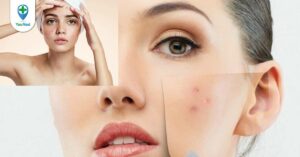 Các loại thuốc kháng sinh trị mụn phổ biến và cách sử dụng