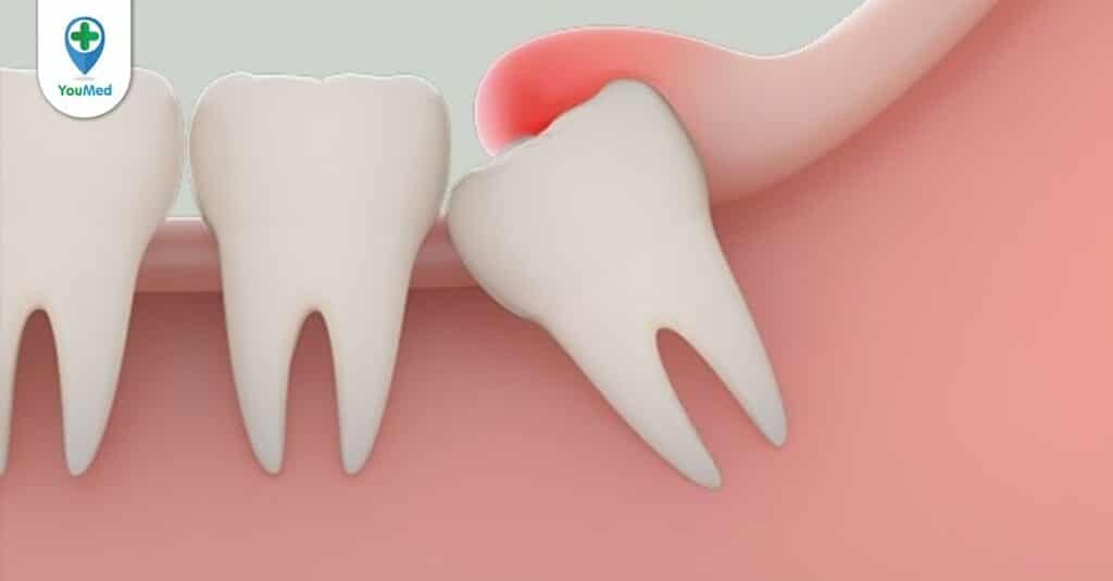 Đau răng khôn và những cách giảm đau bạn nên biết