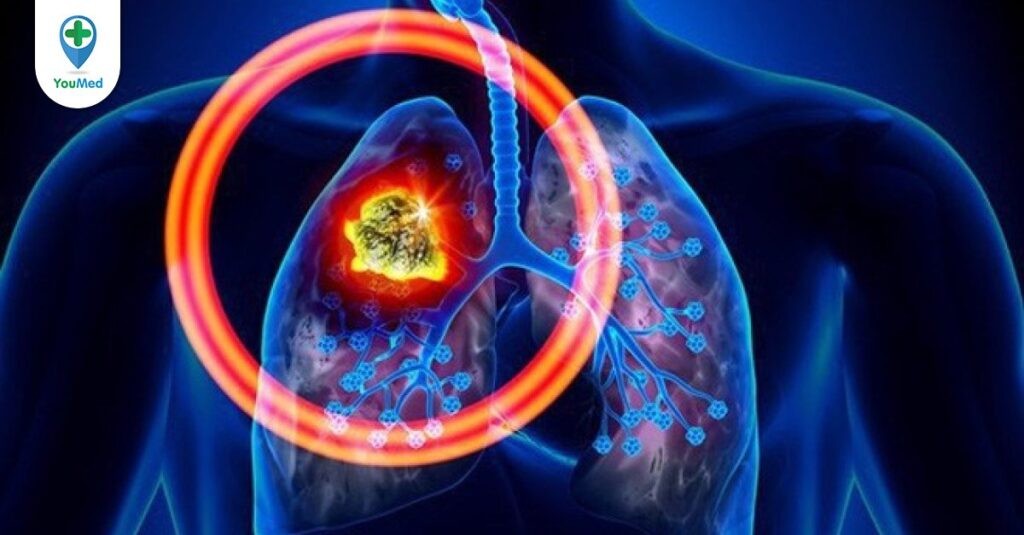 Cùng bác sĩ tìm hiểu về ung thư phổi tế bào nhỏ
