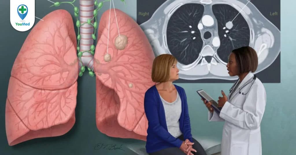 Đặc điểm, dấu hiệu và cách điều trị ung thư phổi giai đoạn cuối