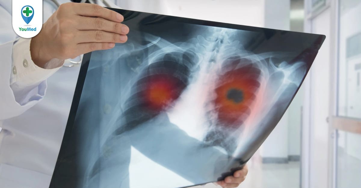 Ung thư phổi di căn xương: dấu hiệu, chẩn đoán và cách điều trị
