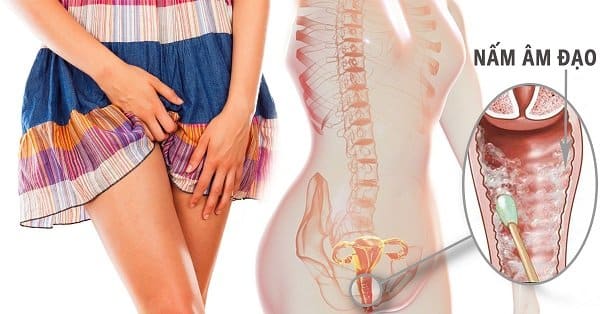 Viêm âm đạo do nấm Candida, liệu bạn đã hiểu rõ - YouMed