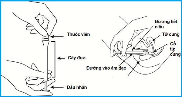 Hình 3: Cách đặt thuốc viêm cổ tử cung dạng viên