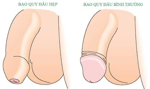 Dấu hiệu hẹp bao quy đầu 