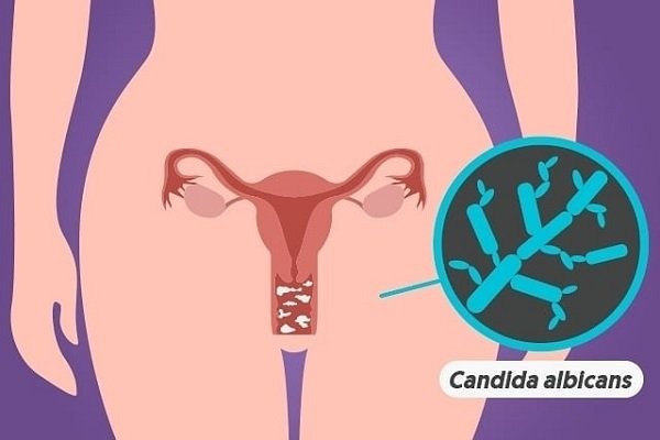 Nấm Candida Albicans là một trong những tác nhân phổ biến gây viêm âm đạo khi mang thai