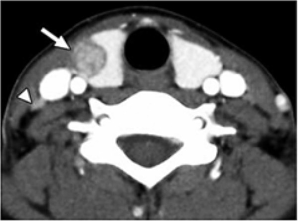Ung thư tuyến giáp thùy phải dạng nhú (đầu mũi tên trắng) đã xâm lấn ra ngoài bao giáp, trên phim CT scan vùng cổ có cản quang