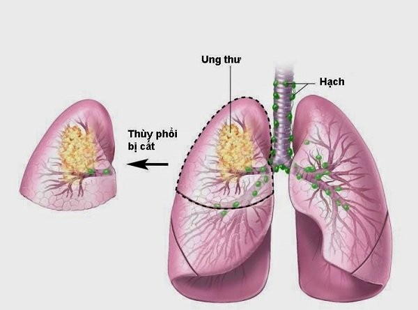 phẫu thuật cắt bỏ thùy phổi