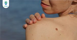 Ung thư tế bào đáy: nguyên nhân, triệu chứng và cách điều trị