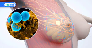 Ung thư vú giai đoạn 3 sống được bao lâu?