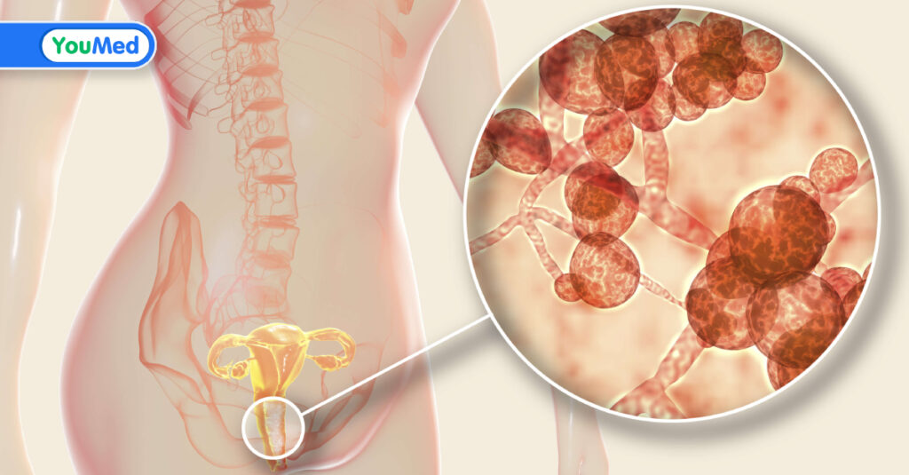 Viêm âm đạo do nấm Candida: Nguyên nhân, triệu chứng, điều trị và cách phòng ngừa