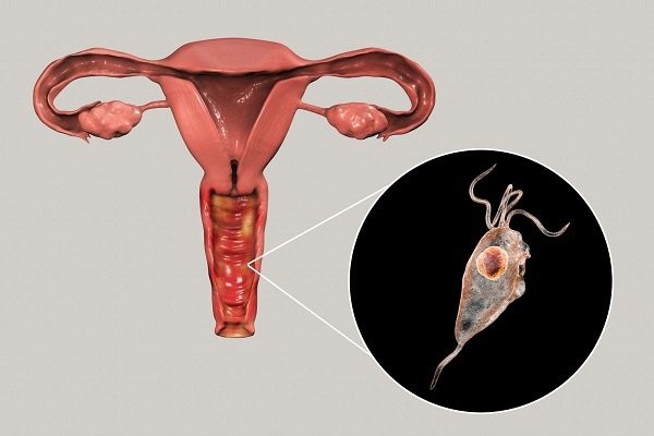 Hình 3: Trùng roi Trichomonas gây viêm âm đạo khi mang thai có thể gây ảnh hưởng đến sức khỏe thai nhi