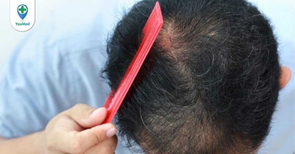 Cách điều trị rụng tóc ở nam giới