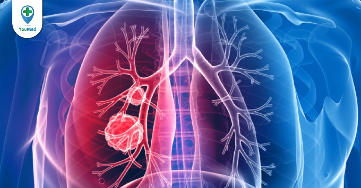 Phương pháp xác định mức độ nặng của ung thư phổi di căn hạch trung thất phổi là gì?
