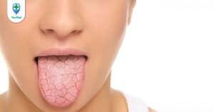 Những dấu hiệu ung thư lưỡi mà bạn nên biết