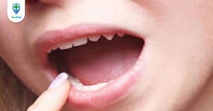 Ung thư lợi: Triệu chứng, chẩn đoán và cách điều trị