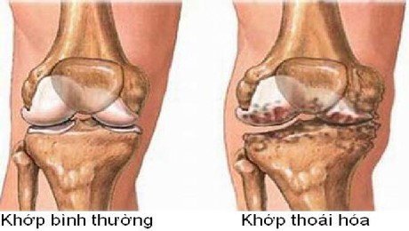 Tình trạng thoái hóa khớp gối