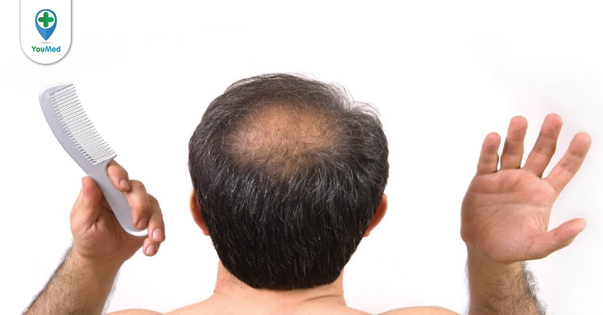 Rụng tóc nhiều ở nam giới Dấu hiệu bệnh tật không thể chủ quan