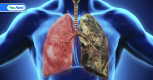 Những nguyên nhân ung thư phổi mà bạn cần chú ý