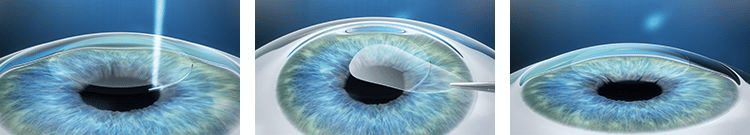 Mổ mắt cận thị và những điều cần biết