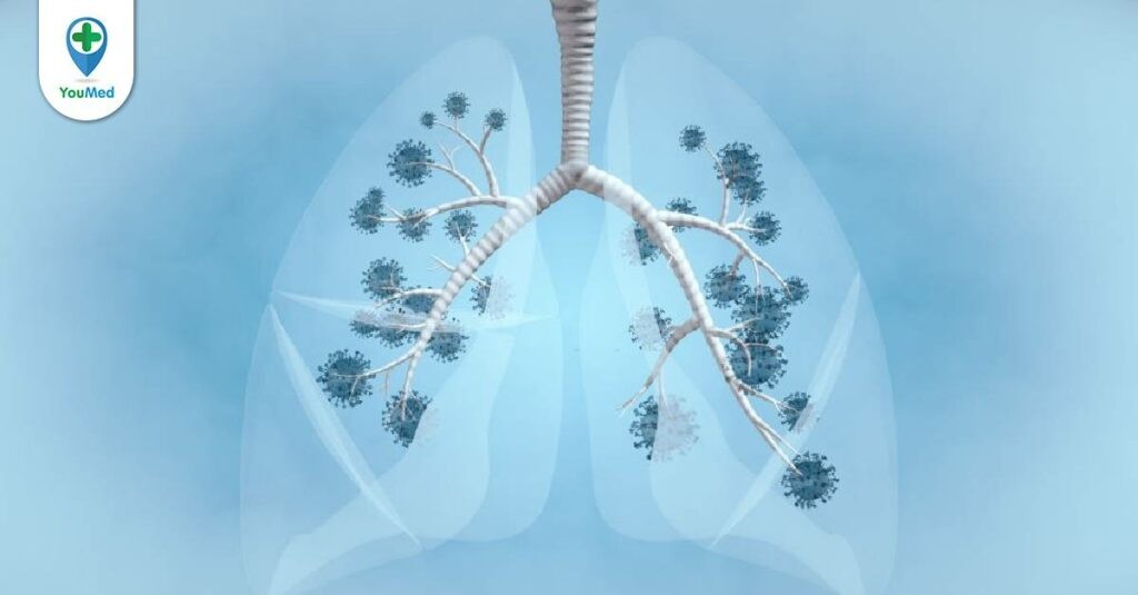 Ung thư phổi không tế bào nhỏ: loại ung thư phổi phổ biến nhất