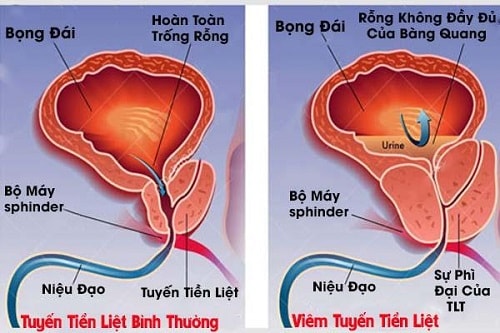 Viêm tiền liệt tuyến có thể gây ra tình trạng tinh dịch bị vón cục