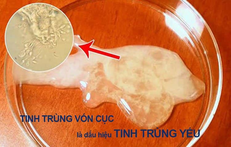 Dấu hiệu tinh trùng yếu vón cục