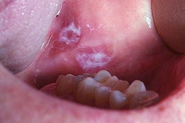 Vết loét không lành trong miệng có thể là dấu hiệu ung thư khẩu cái cứng