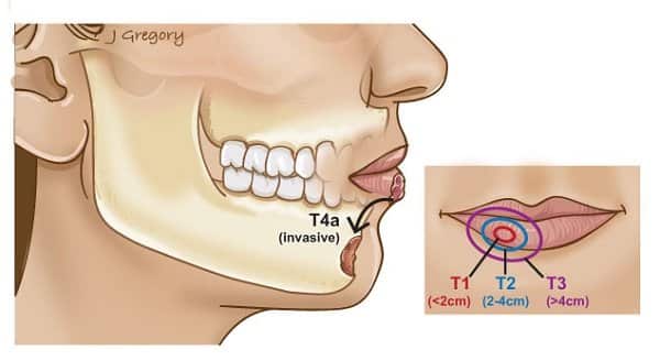 Ung thư khoang miệng sống được bao lâu