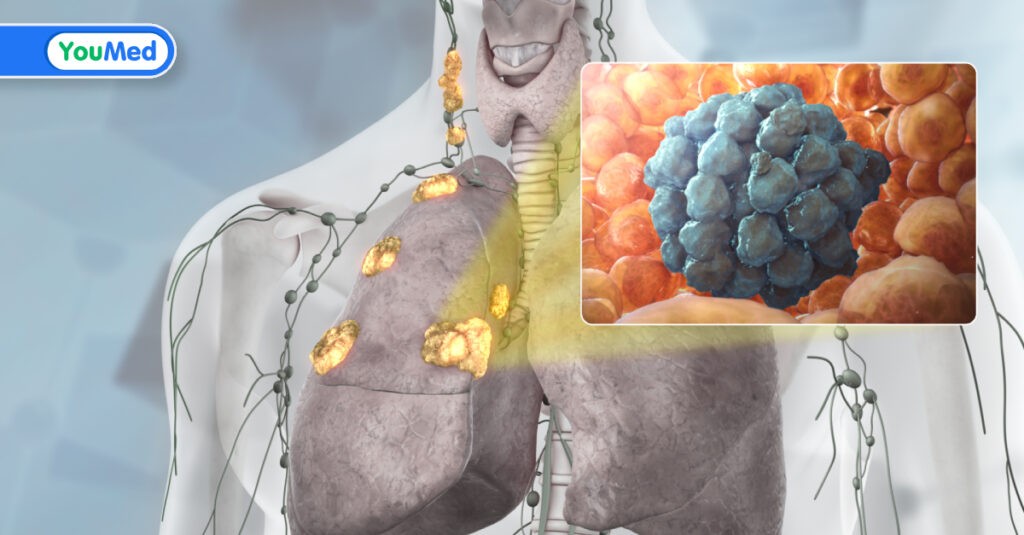Đặc điểm, dấu hiệu và cách điều trị ung thư phổi giai đoạn 3