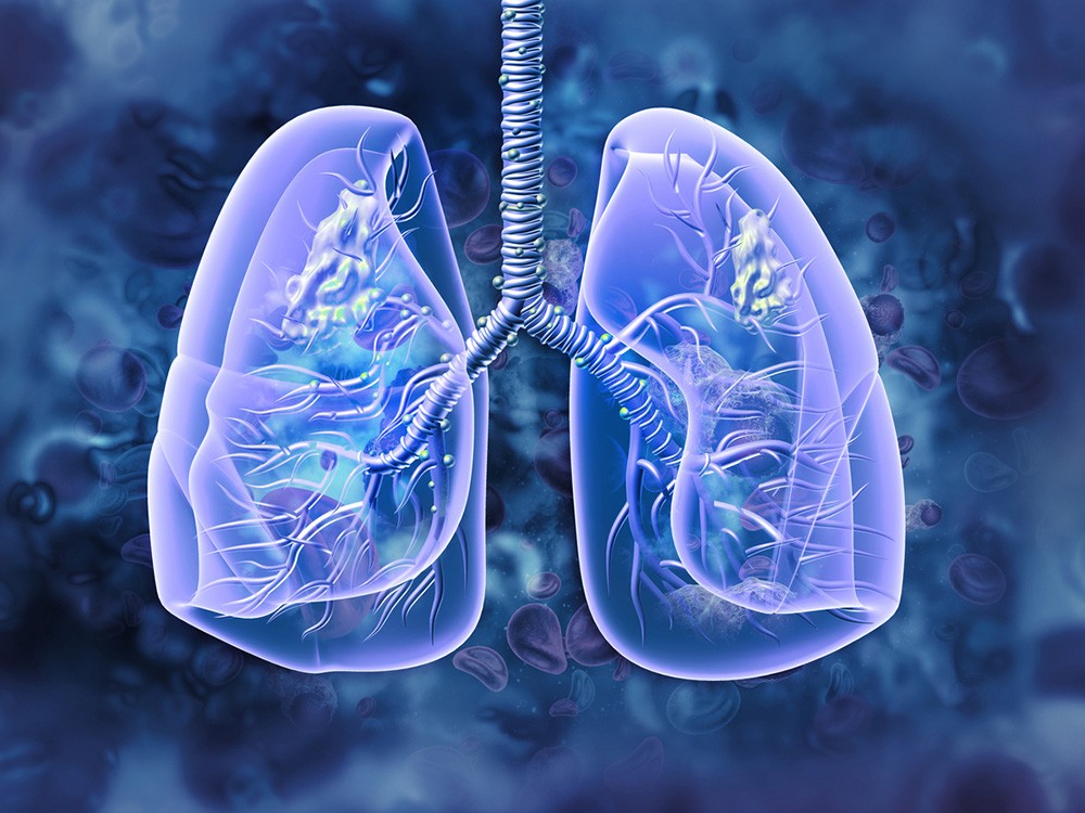 Ung thư phổi sống được bao lâu còn tùy thuộc vào loại ung thư