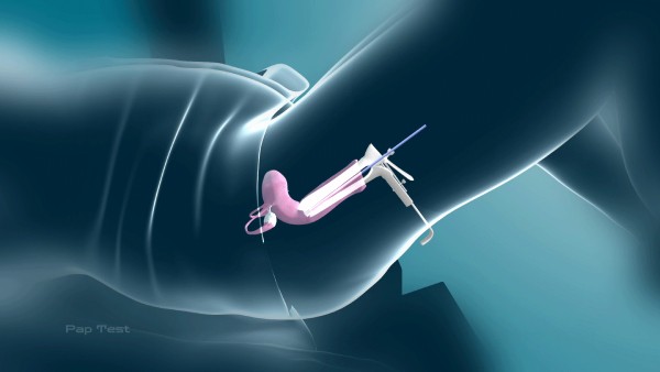 Hình ảnh mô phỏng Quy trình thực hiện xét nghiệm Pap smear