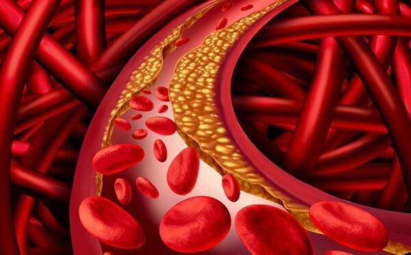Tăng cholesterol máu là biến chứng của suy giáp có thể gây suy tim.