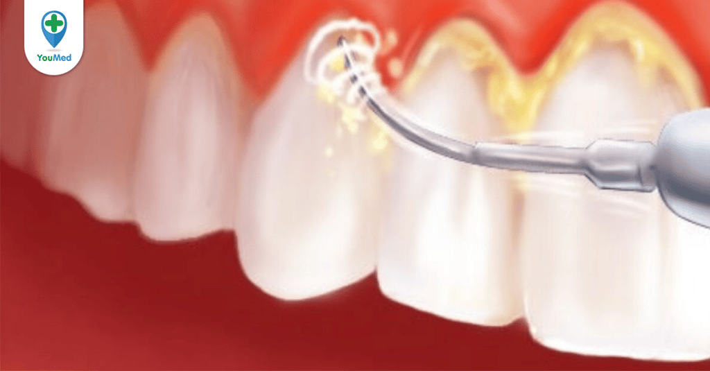 Review cạo vôi răng ở bệnh viện Răng Hàm Mặt TPHCM