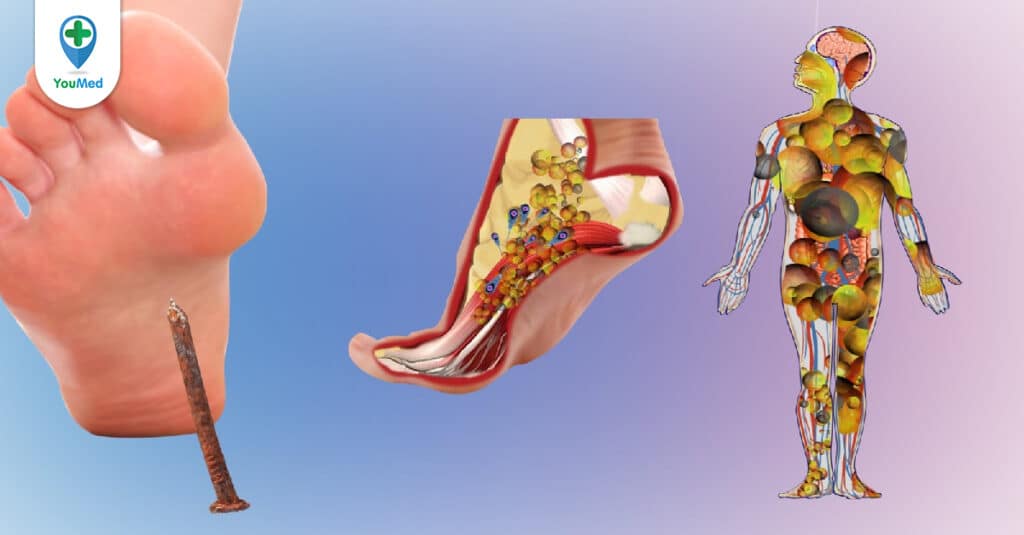 Huyết thanh kháng độc tố uốn ván và những điều cần biết