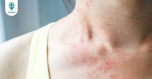 Các loại viêm da và những điều người bệnh cần chú ý