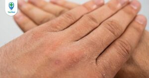 Viêm da tróc vảy: bệnh da hiếm gặp và những điều bạn cần biết