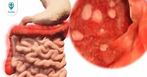 Mối nguy hiểm đến từ căn bệnh ung thư đại tràng di căn