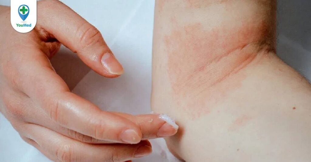 Viêm da cơ địa: Bệnh da phổ biến nhưng liệu bạn đã hiểu đúng về bệnh?