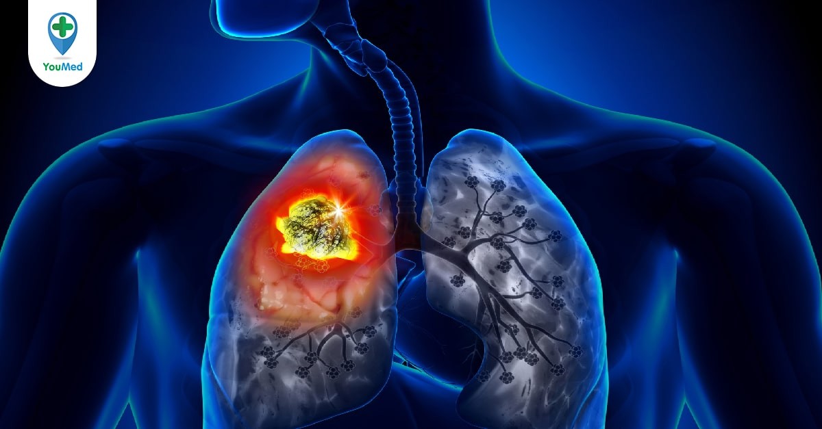 Dấu hiệu ung thư phổi