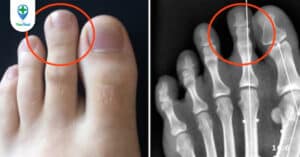 U dây thần kinh morton và những điều bạn cần biết